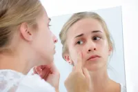 Điều trị mụn