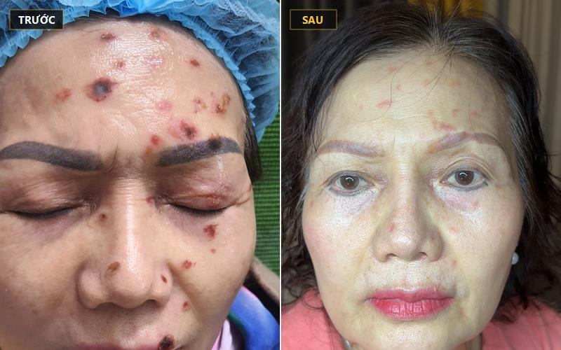 Giải pháp cấp cứu tái tạo màng đáy bằng tế bào gốc và phục hồi Angiopharm sẹo bỏng