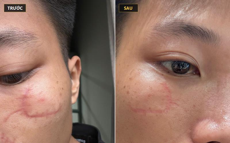 Giải pháp Fusion Plasma làm phẳng gờ xơ và phục hồi vi mạch Angiopharm sẹo phẫu thuật