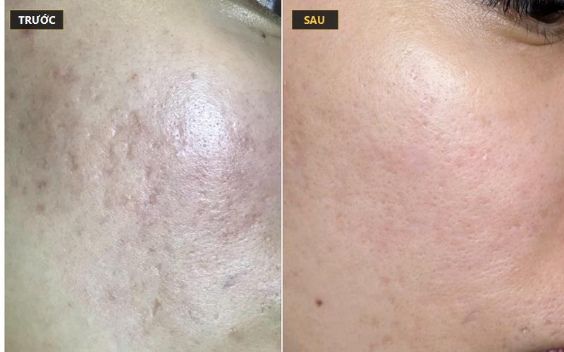 Giải pháp bóc tách vi phẫu, Fusion Plasma và cấy tế bào gốc sẹo rỗ sau mụn